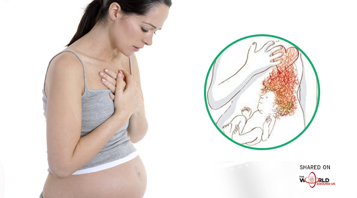 Heartburn-pregnancy